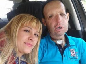 Nakilli yüze nişanlıdan "aşk" öpücüğü