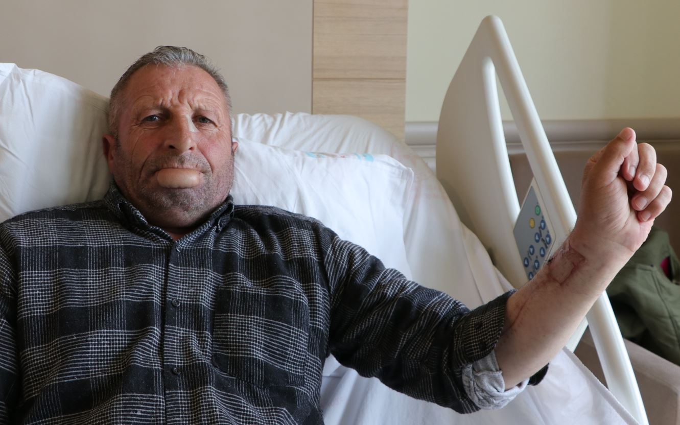 Kol derisinden dudak nakli