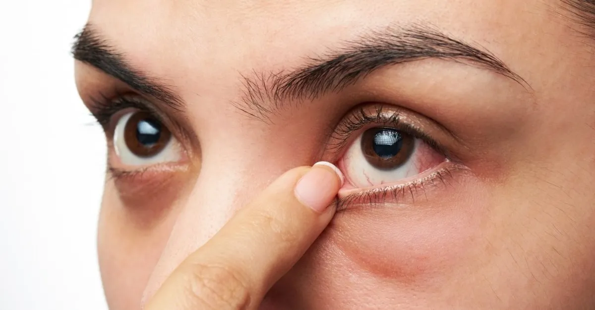 GÖZ ALTI TORBALARINI AZALTMAK İÇİN ÖNERİLER