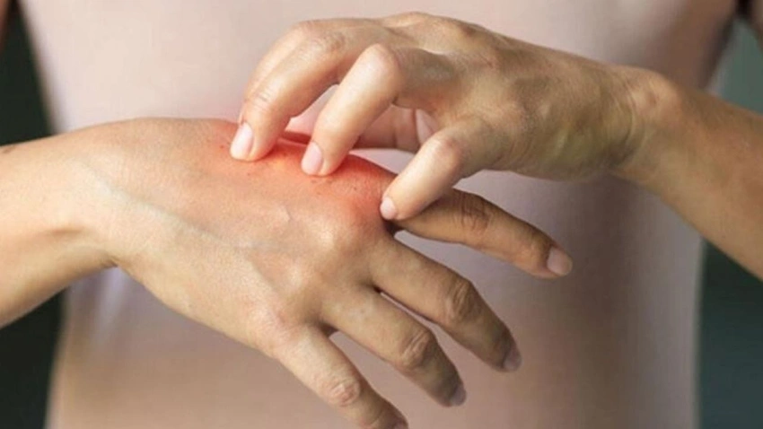 Deride kaşıntı veya kabartı varsa dikkat