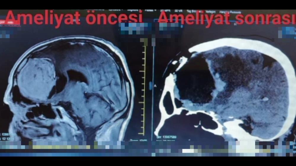 Baş ağrısı için gitti beyninde kitle çıktı
