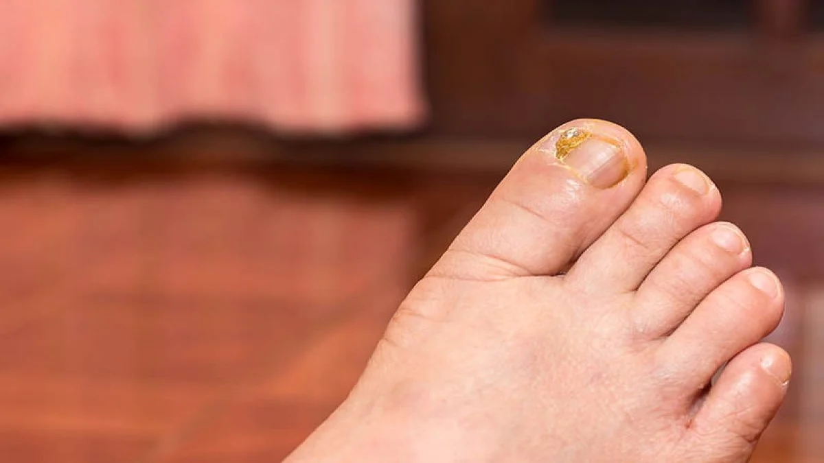 TIRNAK BATMASINDAN KURTULUN