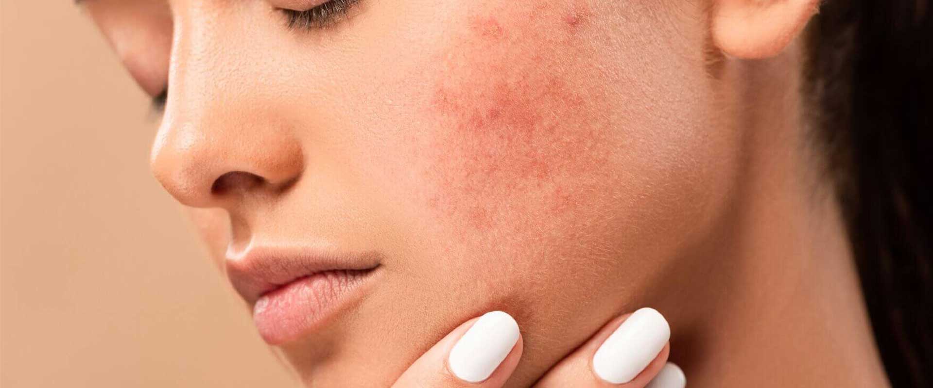 CİLT LEKLERİ KRONİK HASTALIKLARIN HABERCİSİ Mİ ?