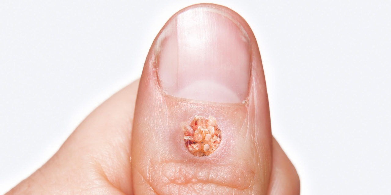 Siğilleri Yok Eden Doğal ve Etkili Çözümler