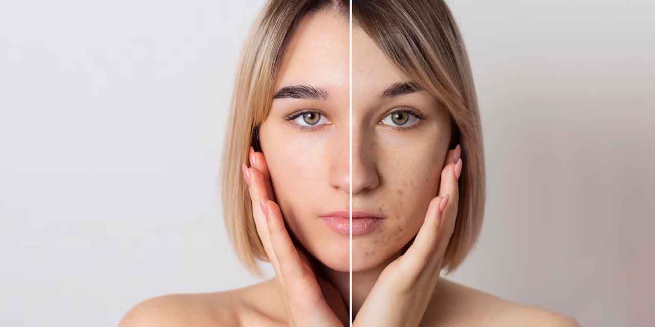 Geçmek bilmeyen sivilceniz varsa endişe etmeyin! Evde 5 dakika'da hazırlayabilirsiniz...Sivilceden birçok şeye iyi geliyor!