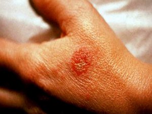 Sinirsel egzama hayatı zehir ediyor