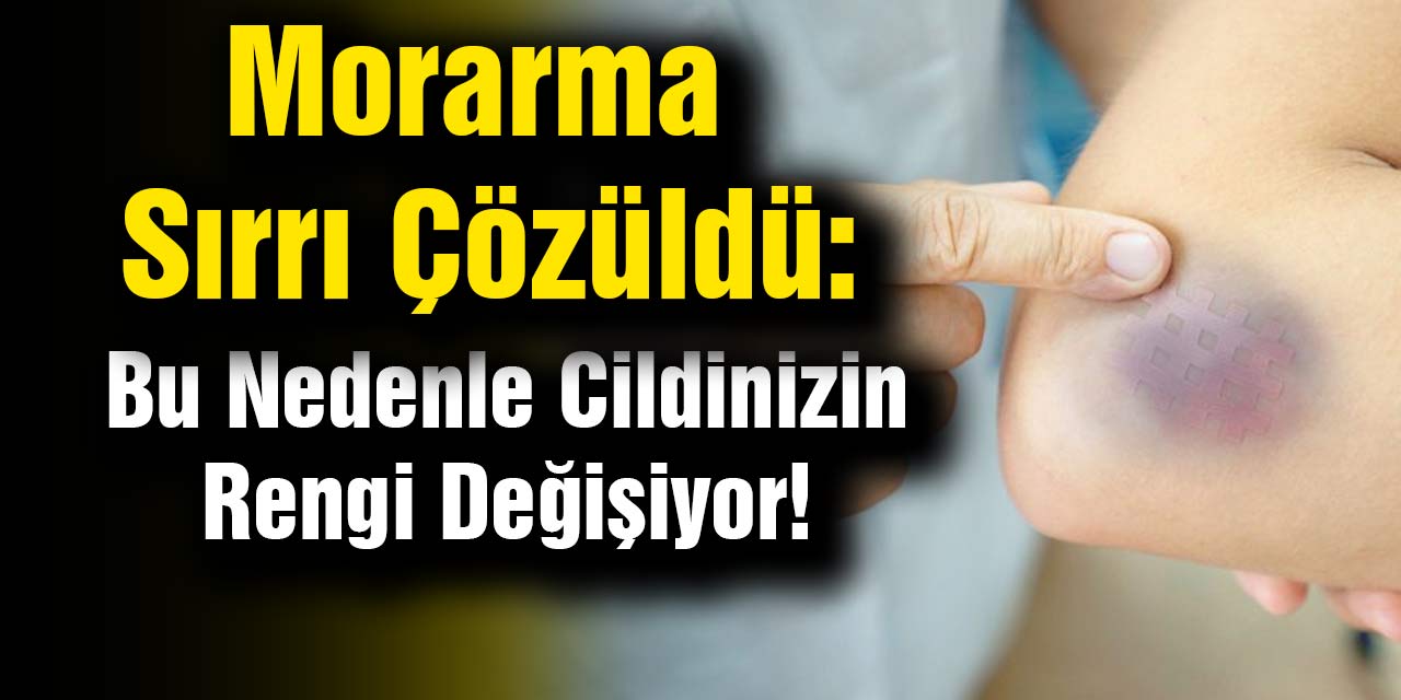 Morarma Sırrı Çözüldü: Bu Şaşırtıcı Nedenle Cildinizin Rengi Değişiyor!