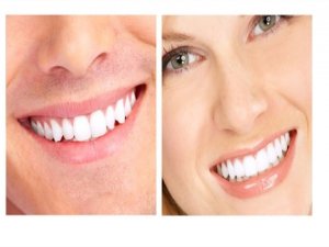 Şimdi moda bu, ‘Gülüş tasarımı’ yaptırıyorlar