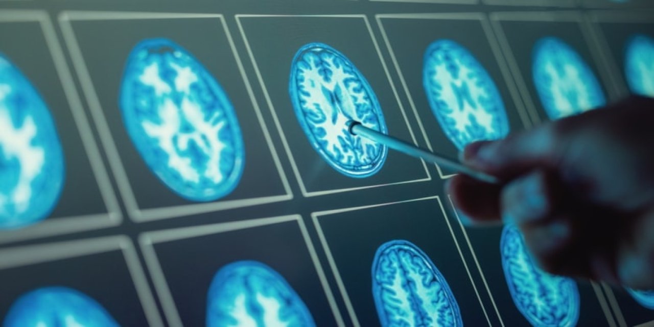 Kan testi ile beyin tümörlerinde erken teşhis