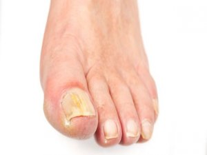 Tatilde sizi bekleyen inatçı tehlike: Mantar