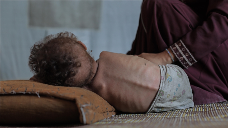 Açlık, Filistinlileri öldürmeye devam ediyor!