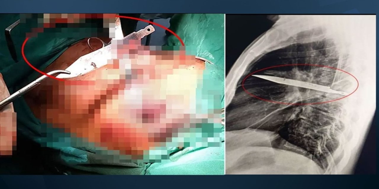 Ağrıyla gitti: 8 yıldır göğsünde bıçakla yaşadığını öğrendi