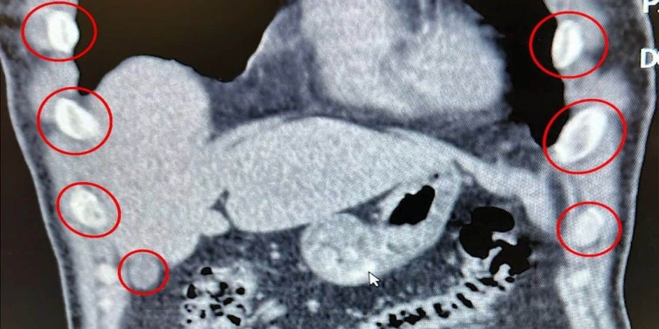 Mideye saklanan 136 uyuşturucu kapsülü ele geçirildi