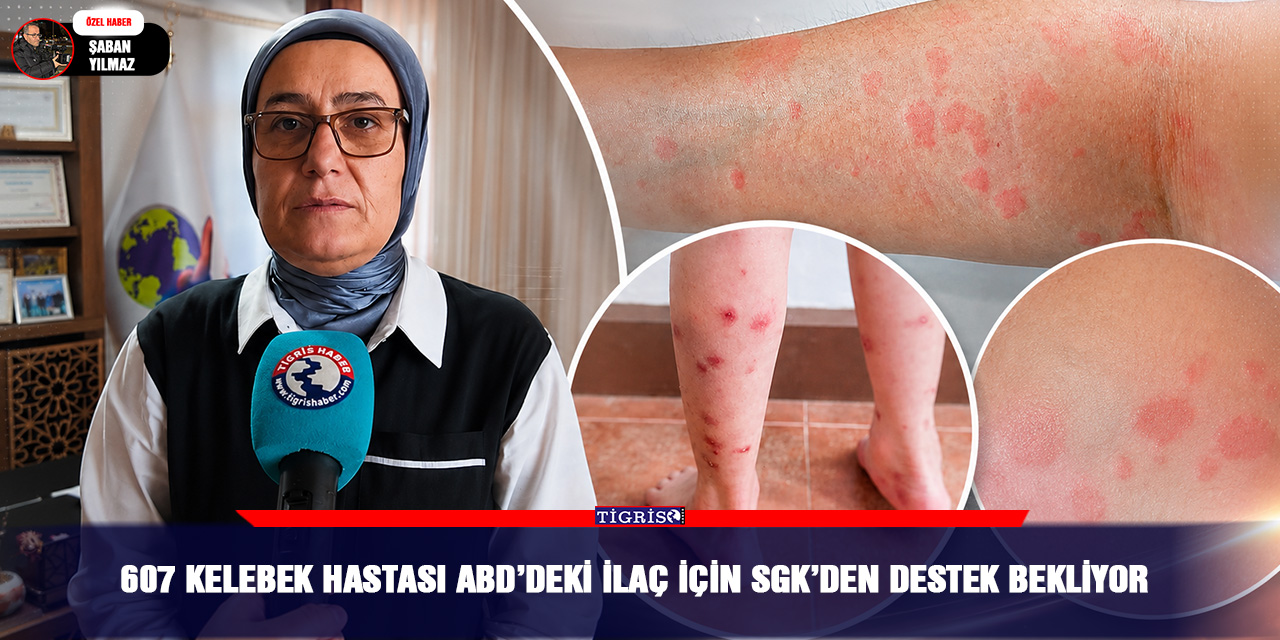 607 KELEBEK HASTASI ABD’DEKİ İLAÇ İÇİN SGK’DEN DESTEK BEKLİYOR