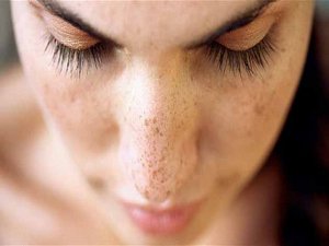 Leke tedavisi nasıl yapılır?