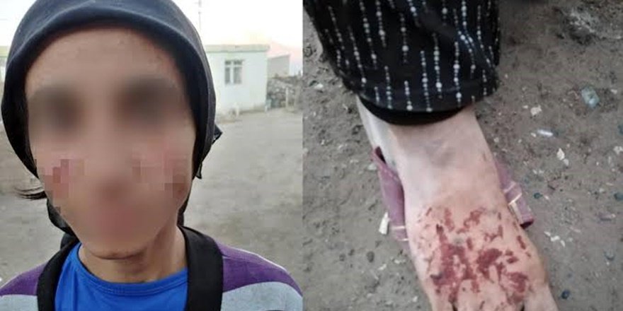Ağrı'da kadına şiddet: Eşi ve kızının yüzünde naylon eritti